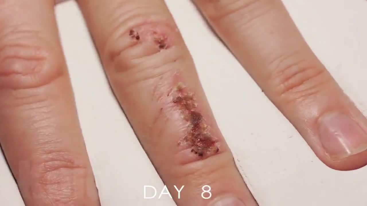 实拍人类伤口在33天内愈合的过程画面高能