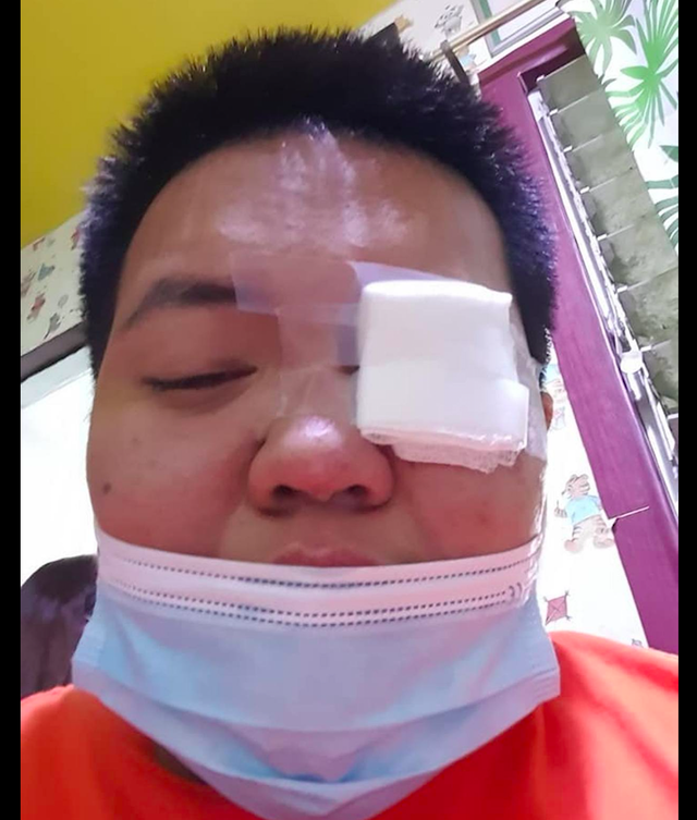 好在狗狗的爪子并不是直接对准眼部的,所以伤口不是特别深,眼睛没有