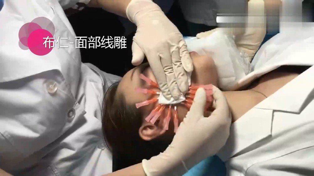 蛋白线埋线提升操作进行中!