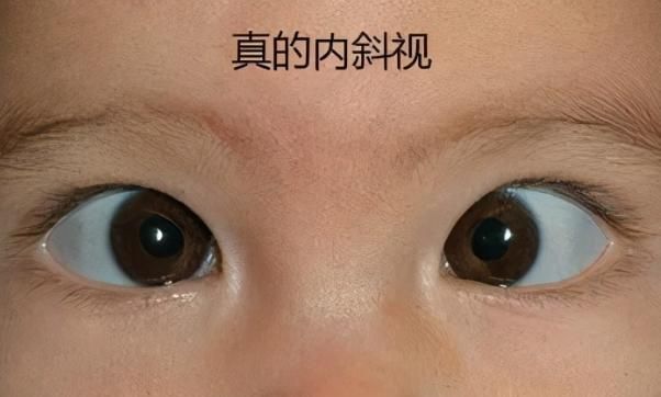 就因为妈妈的疏忽宝宝成了斗鸡眼4个生活细节要重视