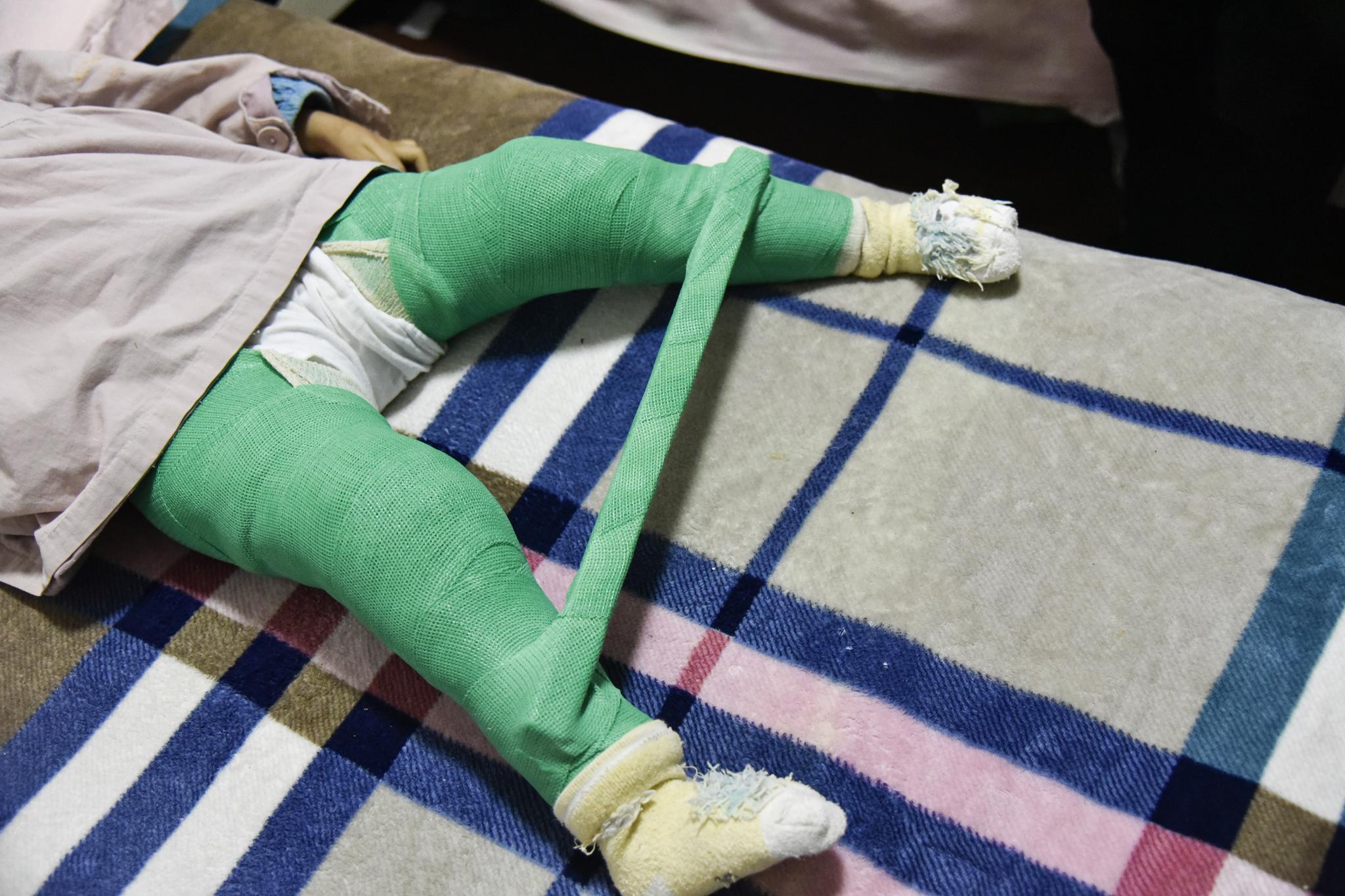 湖南一女孩出生时四肢畸形历经数次手术如今被钢架固定在床上