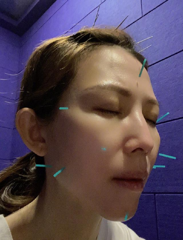 10根针扎脸头皮还有9根,针身细不见影|蔡少芬|针灸|冻龄_新浪新闻