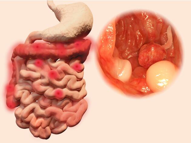 3,大便形状变化:肠道是一个空腔器官,粪便储存时的形状已经被肠道组织