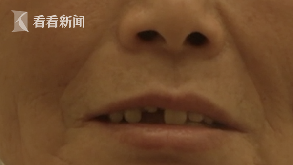 女子花8万元种了6颗牙，没成想第二天吃青菜就掉了一颗休闲区蓝鸢梦想 - Www.slyday.coM