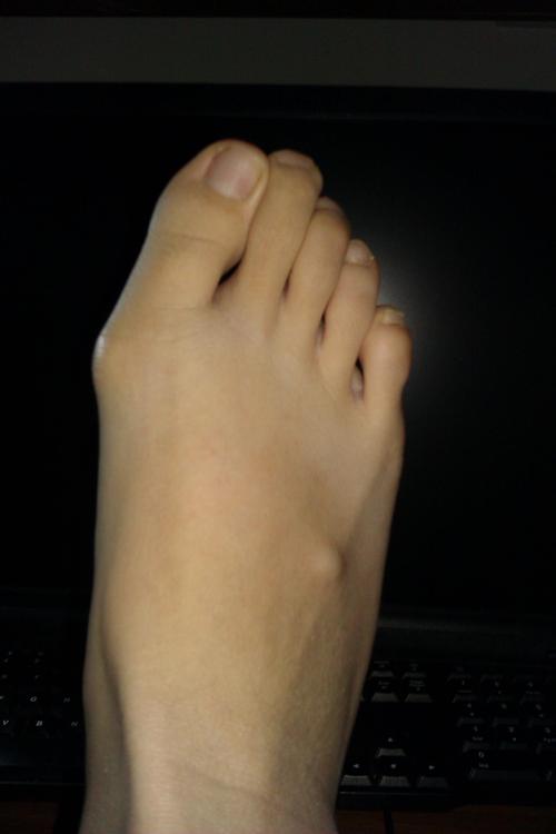 脚上长一个硬小包