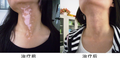 黑色素移植手术?|黑色素|皮肤|表皮_新浪新闻