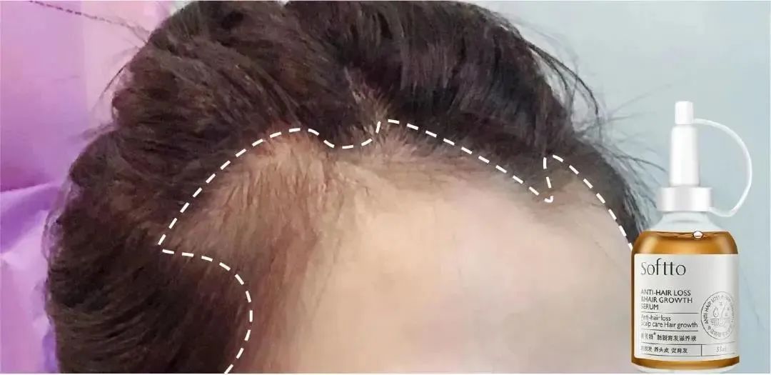 ⊱每天洗头会变秃？别信土办法，这招教你解决掉发、脱发！休闲区蓝鸢梦想 - Www.slyday.coM