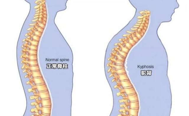 孩子喜欢含胸驼背不仅影响身体发育还可能会影响身心健康