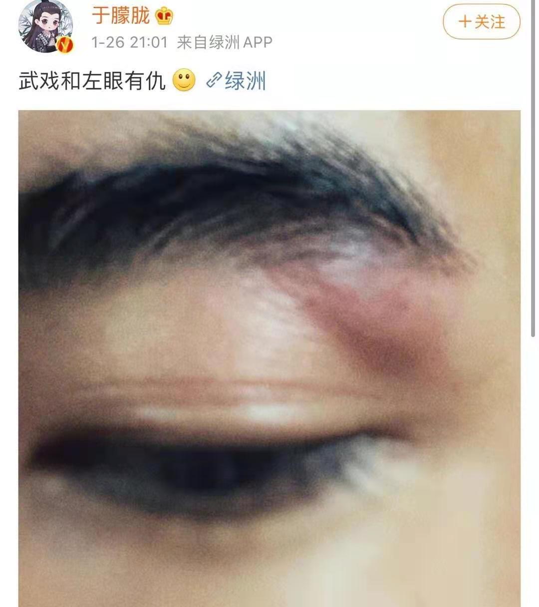 于朦胧拍戏再受伤曾经拍戏因为威亚老师失误导致他腿摔骨折