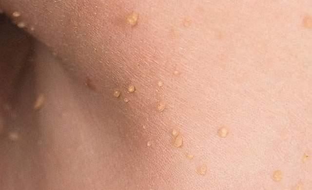 脖子长出小肉粒怎么回事可能是这2种原因别不当回事