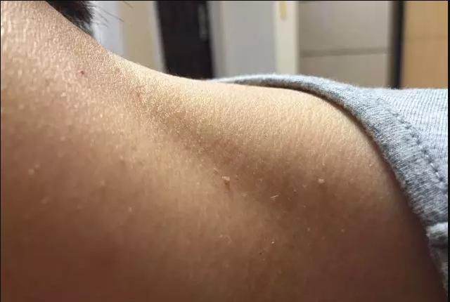 可能是这2种原因,别不当回事|丝状疣|纤维瘤|皮赘_新浪新闻