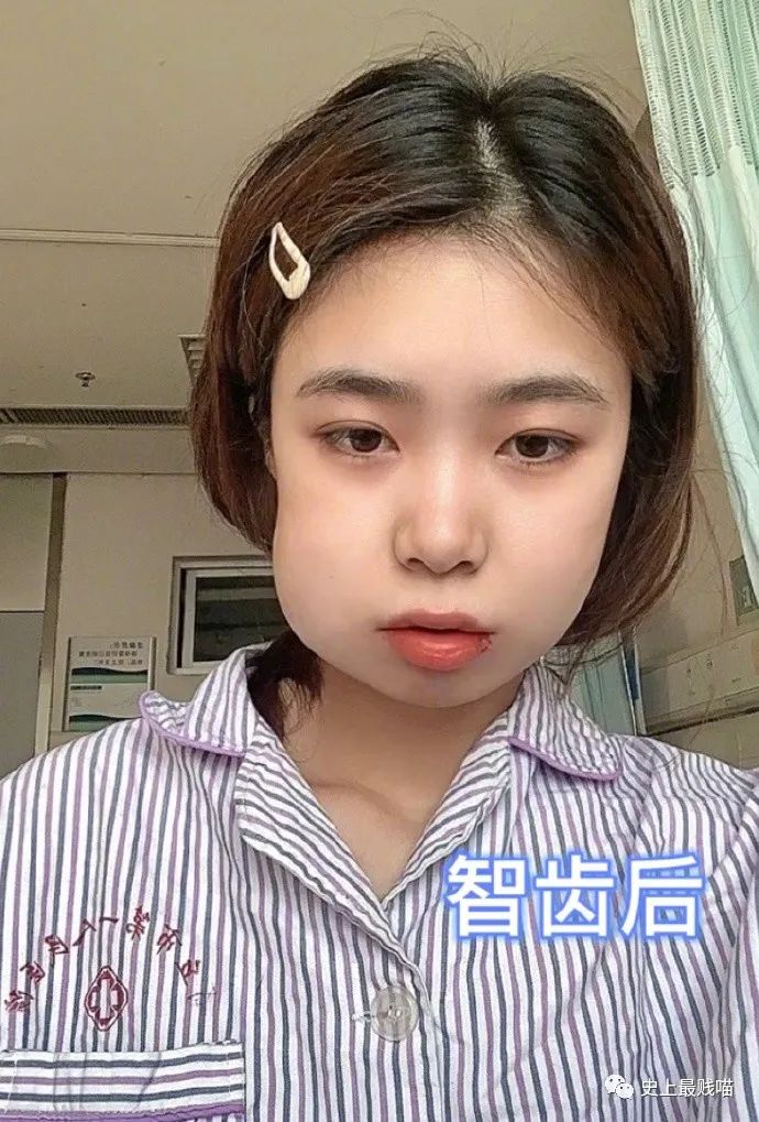 用亲身血的教训最近就有一妹子让不少想要瘦脸的妹子奉为信条拔了智齿