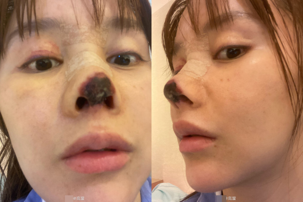 女星高溜整形失败,发文揭圈内整容内幕,违约金医药费令其想轻生