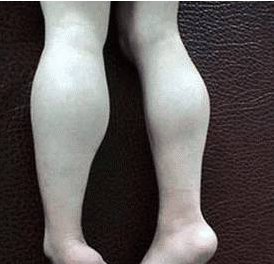 肌无力"与"肌营养不良"的区别|肌营养不良|肌肉|重症肌无力_新浪新闻