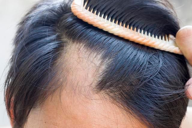 为什么头发越来越少?可能和这8种因素有关,希望你不会"秃顶"