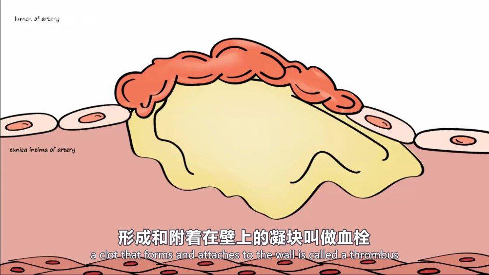 医学双语科普:动脉粥样硬化的病理 视频翻译by