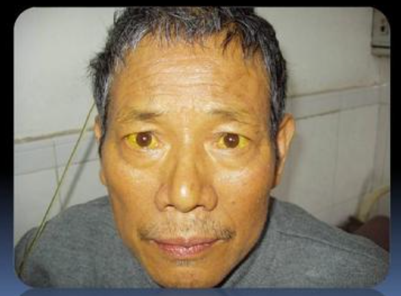 2,黄疸:成年人黄疸都属于病理性黄疸,这是胆红素代谢障碍的典型表现.