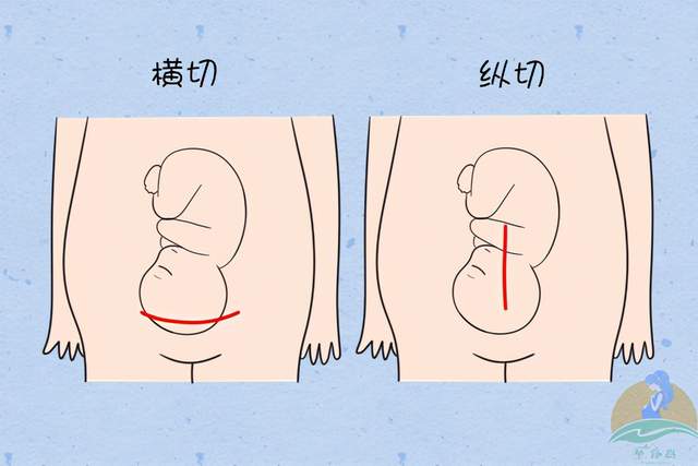 剖宫产刀口位置图片