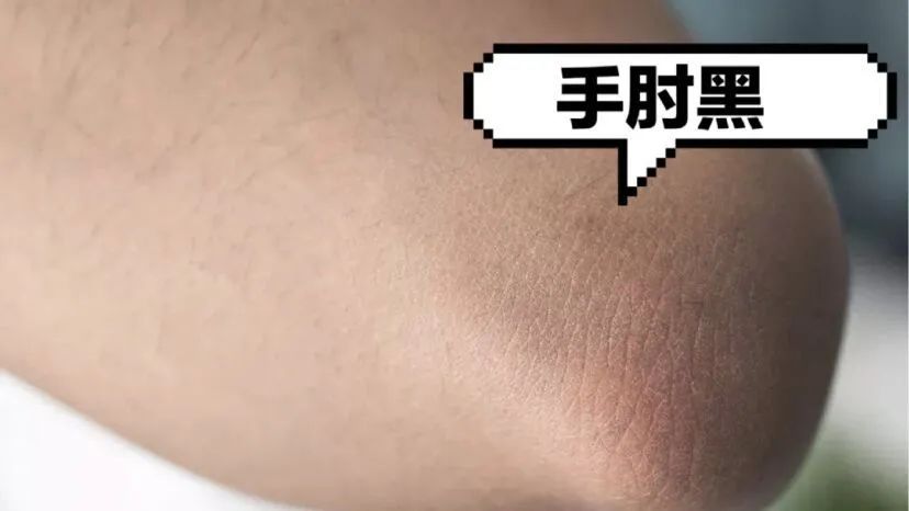 手肘里有鸡皮疙瘩图片(胳膊肘起鸡皮一样的疙瘩) 手肘里有鸡皮疙瘩图片(胳膊肘起鸡皮一样的疙瘩)