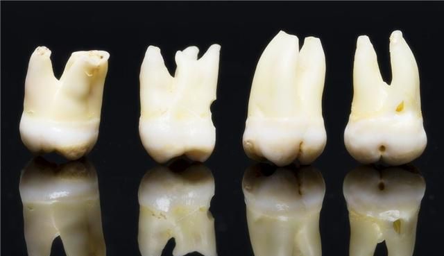 智齿|拔牙|磨牙_新浪新闻