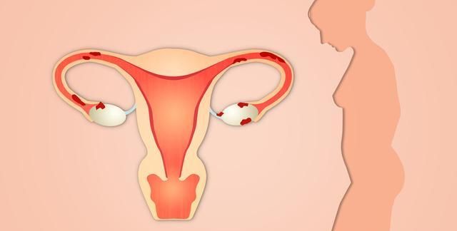 发现子宫肌瘤必须治疗吗如果肌瘤非常大或位置不好需手术处理
