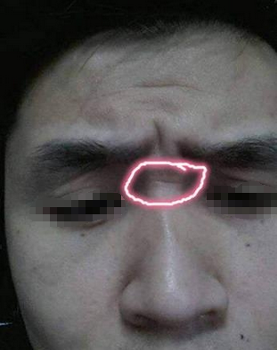 山根在面相学当中代表夫妻座,这里是夫妻关系的位置,如果这里有横纹的