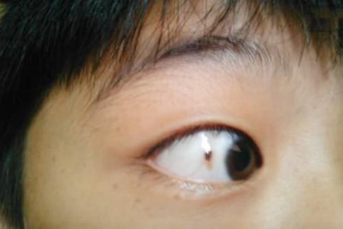 孩子眼球长"黑点",家长别忽视,北大医师表示:不只是色素沉着