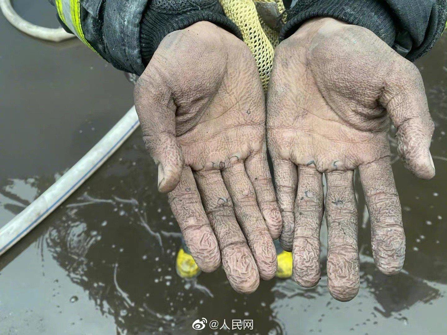 你愿意为他们转发吗?这是一双消防员刚下火场的手