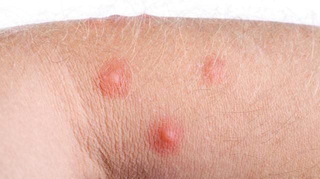 00后情侣双双查出hpv专家无论男女身体长疙瘩早查hpv