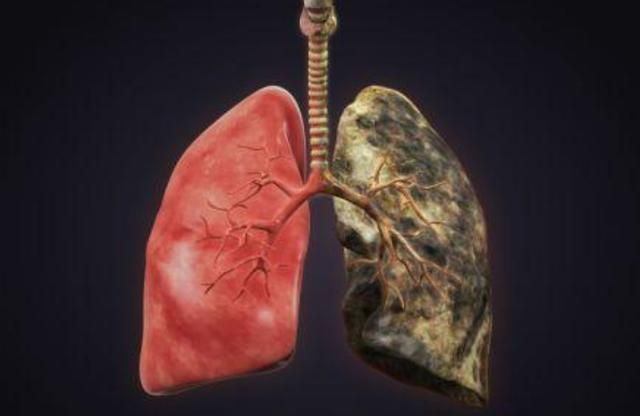 肺病狡猾一查就是晚期其实双腿早给了暗示多数人却不知道