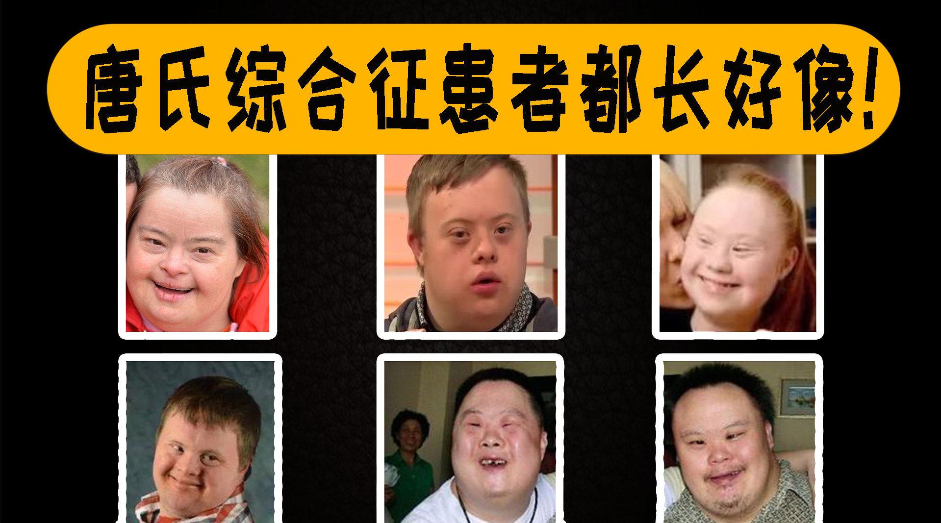 为什么患唐氏综合征的人,感觉都长差不多?