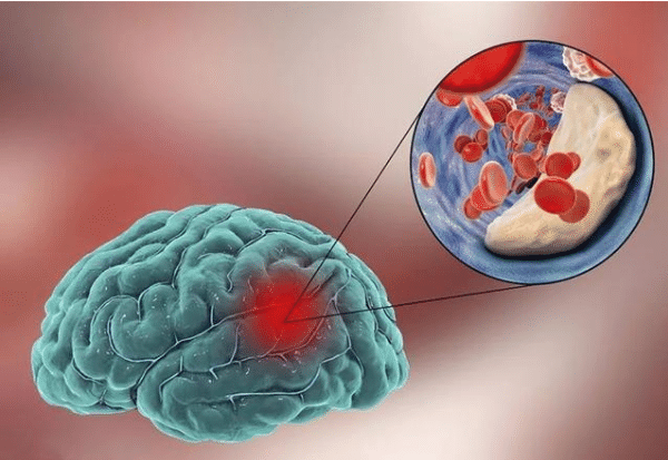 突发脑颤怎么急救