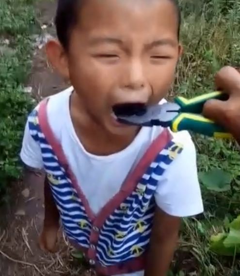 8岁男孩拔牙一把钳子拔掉了都夸男孩好勇敢