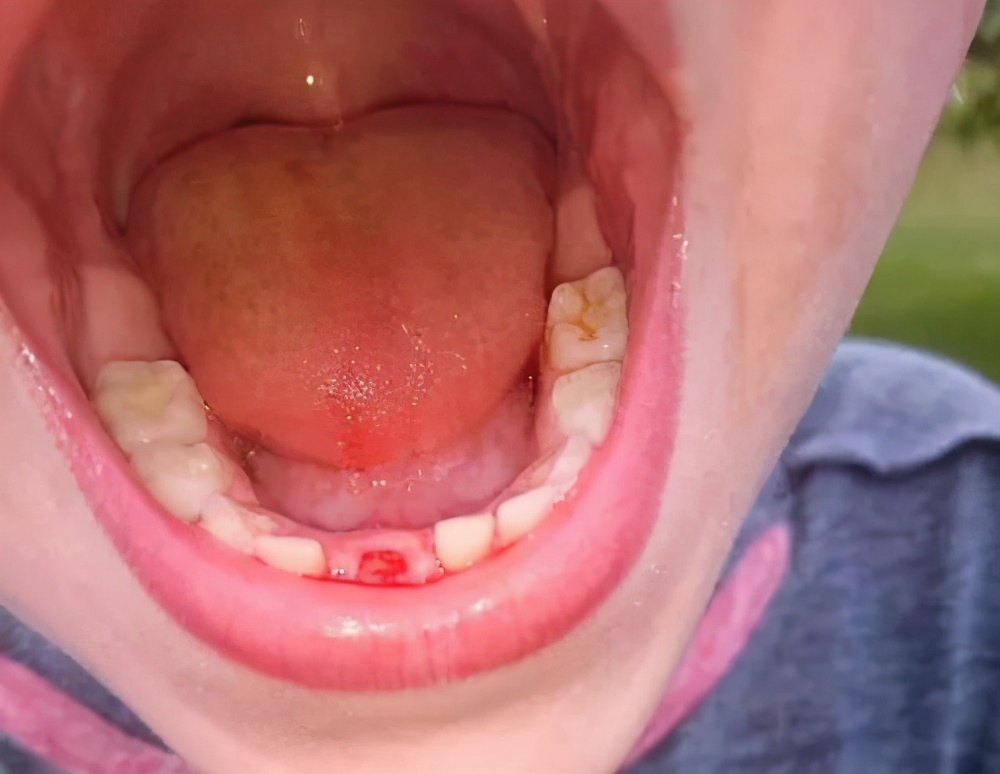 孩子换下的乳牙不要扔关键时刻能救命满足这些条件就能用