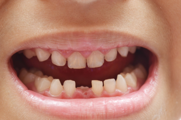 刚开始长牙的时候,我家周围的邻居会问我,为什么孩子牙齿的缝隙这么大