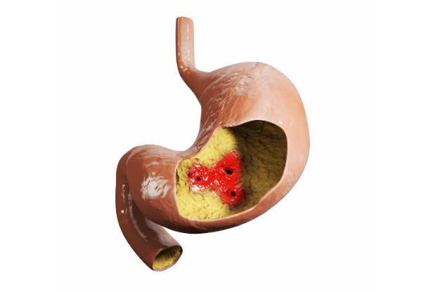 胃癌查出多是中晚期?医生:四类人体检,这项检查不能省|胃病|胃癌|胃镜