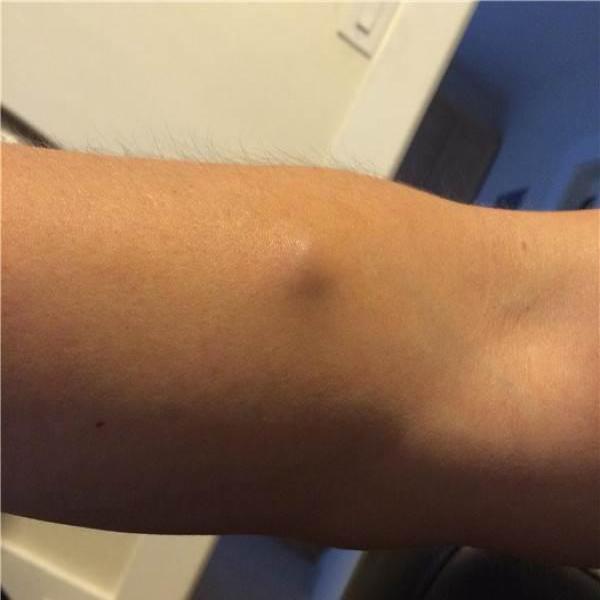 男子右手手臂鼓起大包,医生检查之后,发现里面藏着这东西