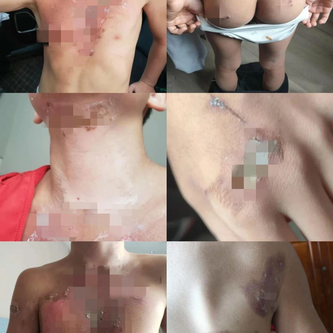 泼开水、烟头烫、甩棍打……5名10岁体操队员遭暴力殴打！到底发生了啥？|王杰|家长|学校|刘昊|小凯_手机新浪网