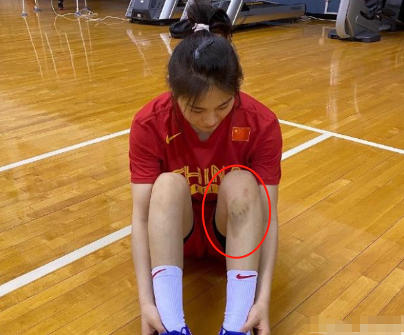 根据媒体的爆料,王思雨在近日遭遇了膝盖伤势,她是在训练中不慎受伤的