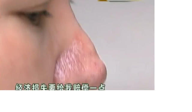 女子花3万整容,不料越整越难看,负责人:你的手术是成功的休闲区蓝鸢梦想 - Www.slyday.coM 女子花3万整容,不料越整越难看,负责人:你的手术是成功的休闲区蓝鸢梦想 - Www.slyday.coM