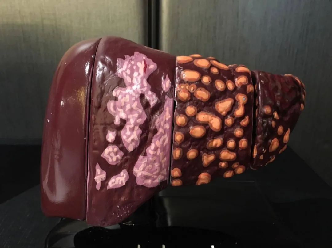 常喝酒的人酒后出现三个异常表现不用怀疑肝已严重受损