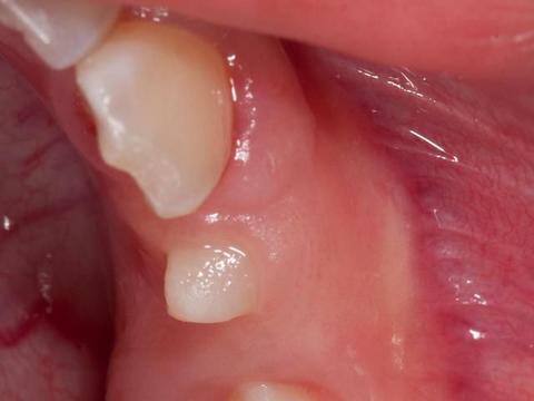 色素沉着图片真实牙齿 33a1-knaqvqn3194640.jpg