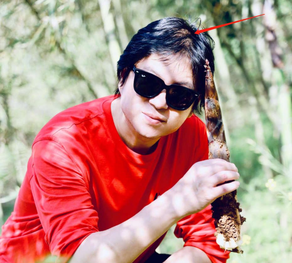 头顶稀疏疑似脱发,暴瘦30斤下巴变尖