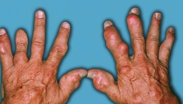 痛风患者注意了,防病先防食,3大类高嘌呤食物,不妨了解一下