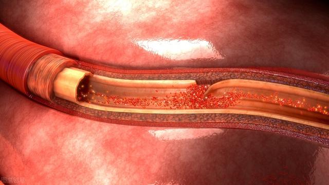 命悬一线!男子不慎从高地坠落,主动脉夹层差点"引爆"血管