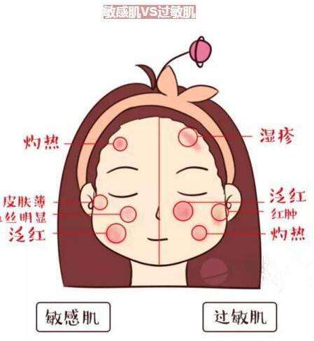正文   敏感肌肤的特征   敏感肌肤最大特征就是皮肤薄弱,皮脂分泌少