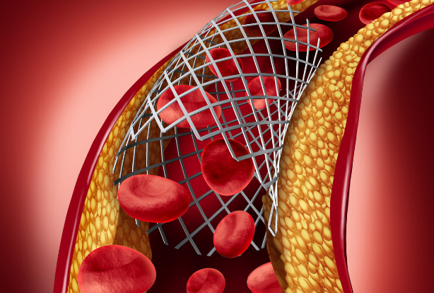 做好4个方面,一样能健康长寿|支架|心脏|心血管_新浪新闻