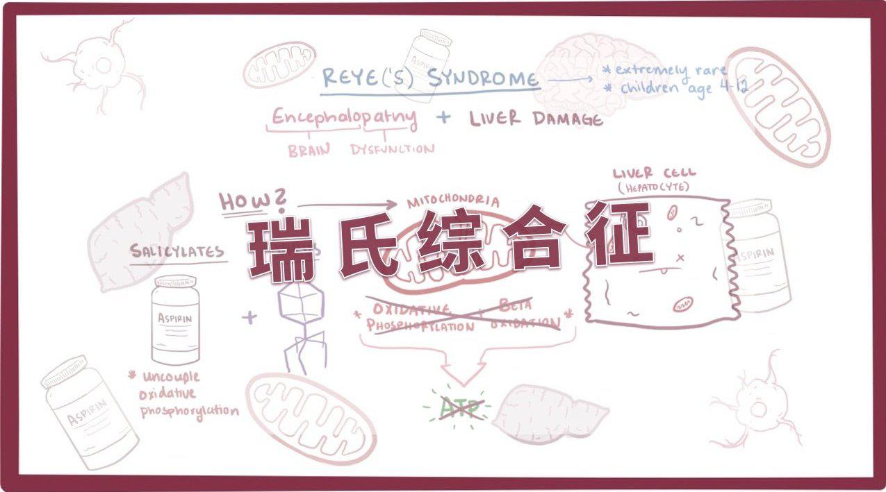 瑞氏综合征 reye syndrome