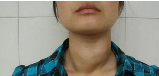 同是甲状腺患者为何有的能调养而有的要住院医生错在拖延