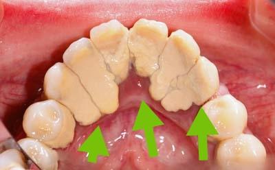 牙龈有血丝口腔明显臭味这是怎么了